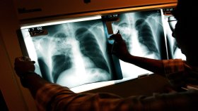 Sigue viva la alerta por tuberculosis