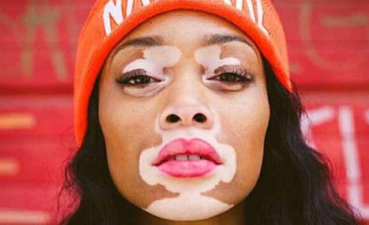 Winnie Harlow era una joven que soñaba con ser modelo en su Toronto natal, de donde emigró hacia California para empezar su lucha.