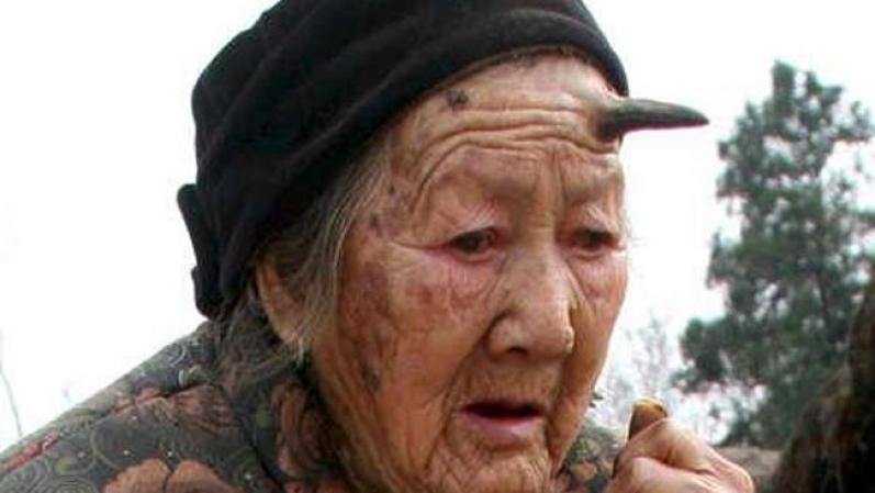 Anciana desarrolla un cuernoLa extraña protuberancia mide unos seis centímetros y no le causa molestía.
