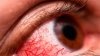 Nueva variante de covid-19 tiene síntomas diferentes, incluyendo un tipo de mal en los ojos