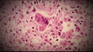 measles under a microscope
