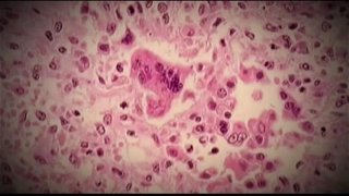 measles38