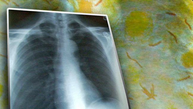 tlmd_eduardo_rosas_cruz_tuberculosis_california