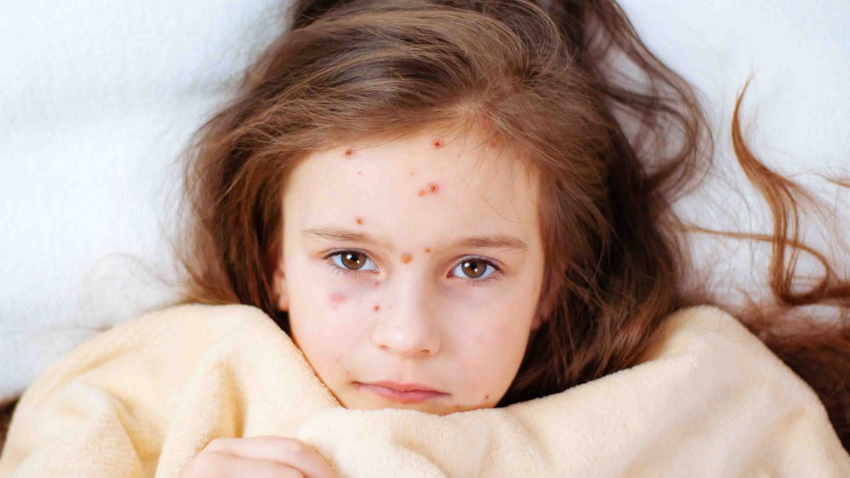 Корь новости 2024. Корь в россии. Корь новости 2024. Корь в ленинградской области. Корь симптомы у взрослых 2023.
