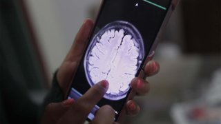 Un equipo de científicos de la Northwestern University, en Estados Unidos, ha conseguido por primera vez que la quimioterapia más potente llegue al cerebro para tratar los gioblastomas, el tumor cerebral más agresivo y común.