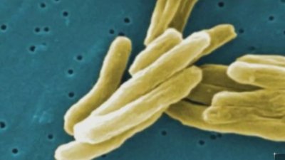 Preocupación crece tras el brote de tuberculosis en Long Beach