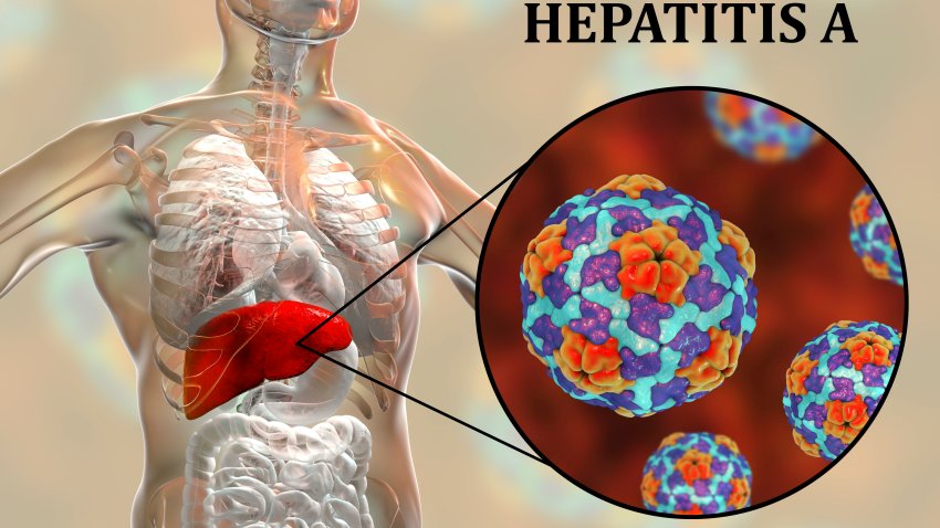 Hepatitis A infection. Computer illustration showing the liver and a close-up view of hepatitis A viruses.